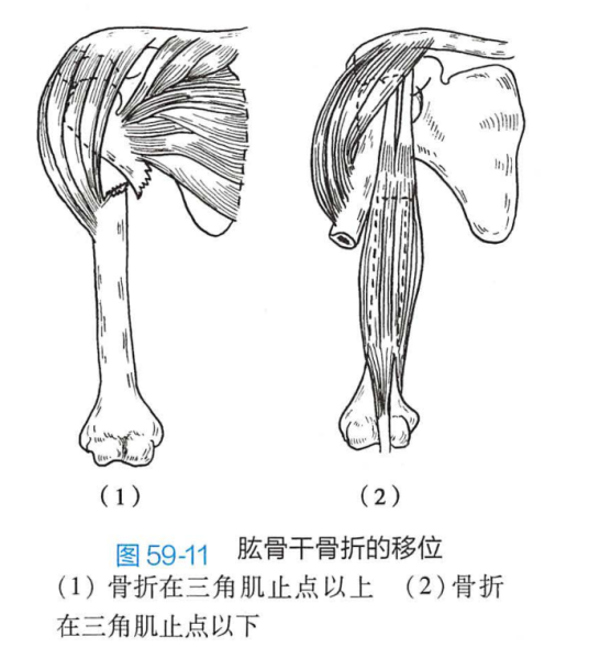 肱骨干骨折