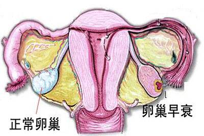 卵巢功能性早衰