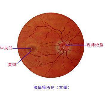 先天性视神经萎缩