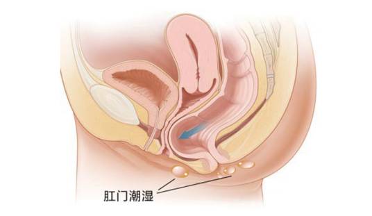 肛周皮肤湿疹