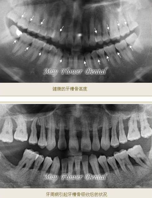 牙槽骨吸收