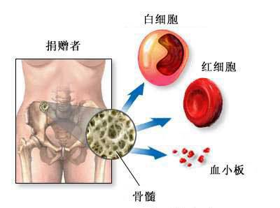 移植骨髓