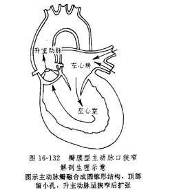 主动脉口狭窄