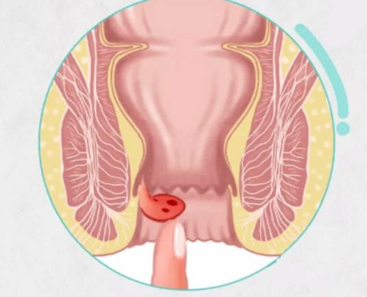 血栓外痔