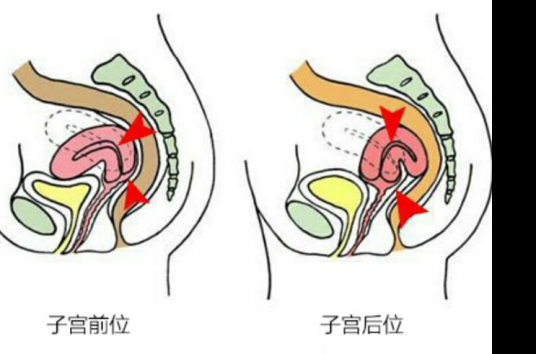 前位子宫