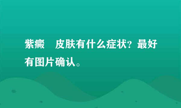 紫癜 皮肤有什么症状？最好有图片确认。