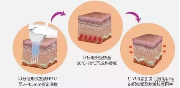 超声刀的作用与原理是什么？