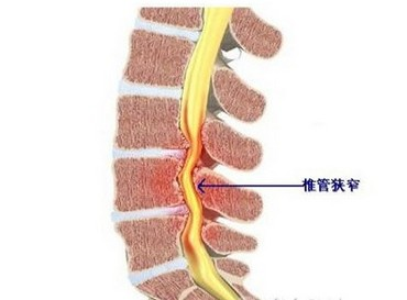 什么是来自腰椎管狭窄