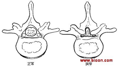 什么是来自腰椎管狭窄