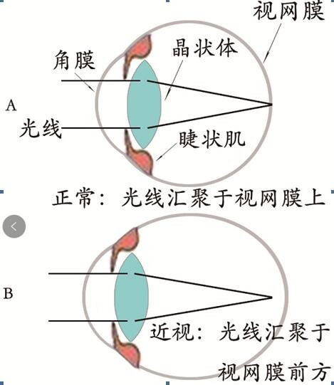 视力怎么恢复？