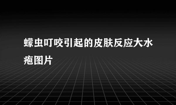 蠓虫叮咬引起的皮肤反应大水疱图片