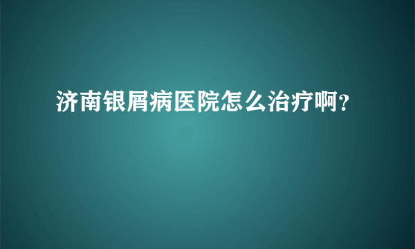 济南银屑病医院怎么治疗啊？