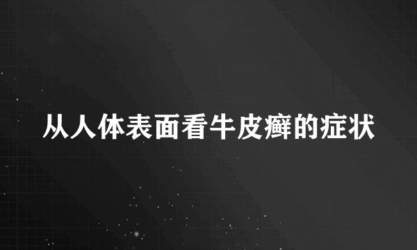 从人体表面看牛皮癣的症状