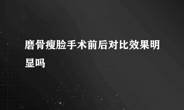 磨骨瘦脸手术前后对比效果明显吗