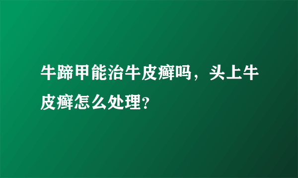 牛蹄甲能治牛皮癣吗，头上牛皮癣怎么处理？