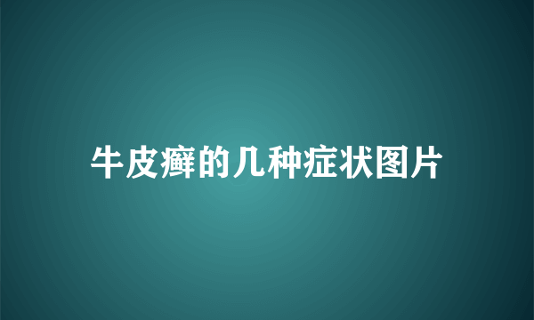 牛皮癣的几种症状图片